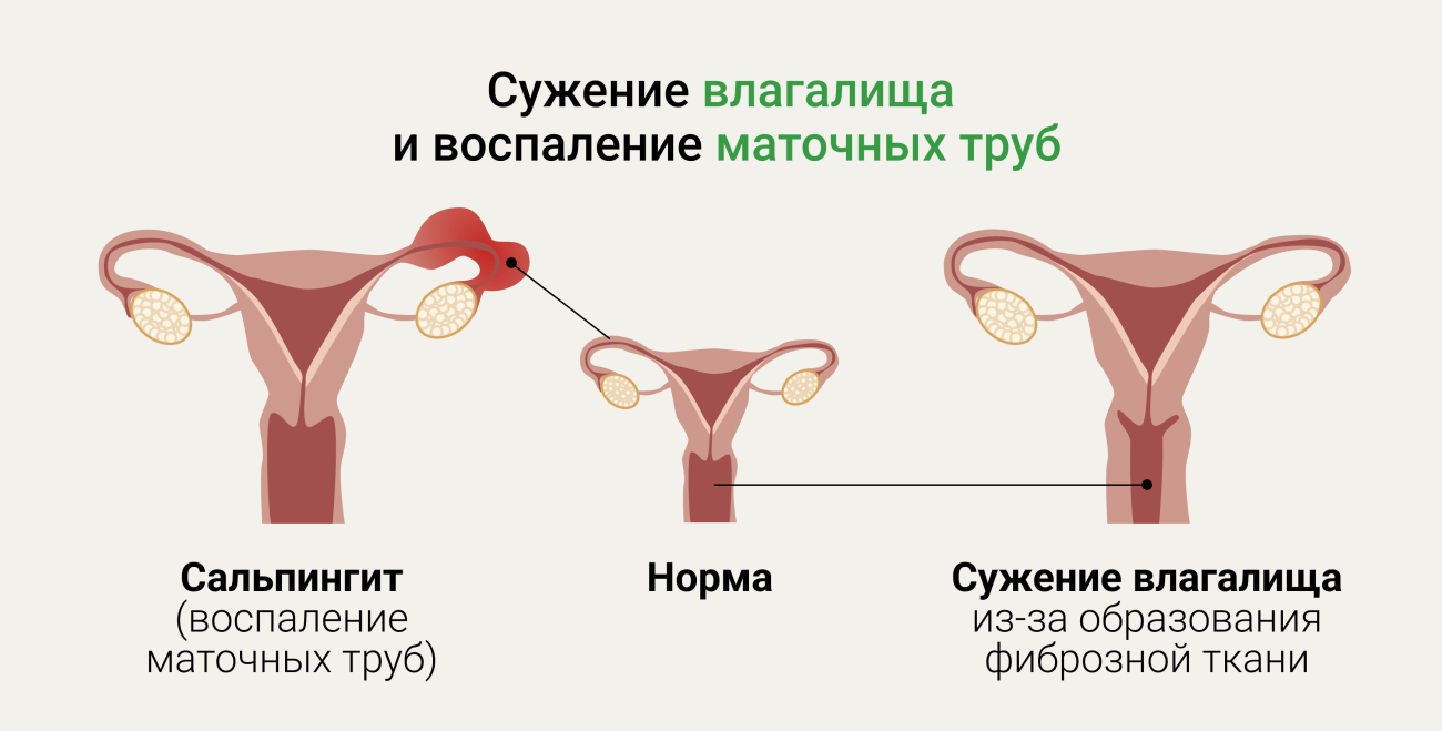 Белые выделения из влагалища: симптомы, причины и методы лечения в «СМ-Клиника»