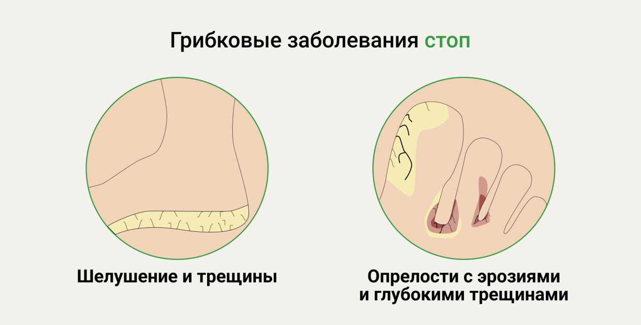 Межпальцевые микозы (грибок) | Центр подологии и остеопатии Татьяны Красюк
